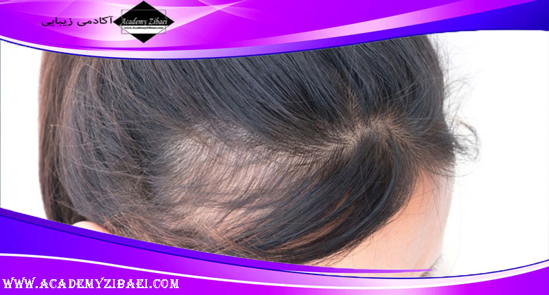علل و علائم آلوپسی و ریزش مو چیست؟